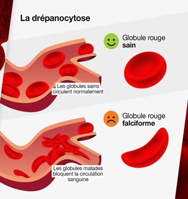 Globules sains vs globules falciformes – circulation sanguine